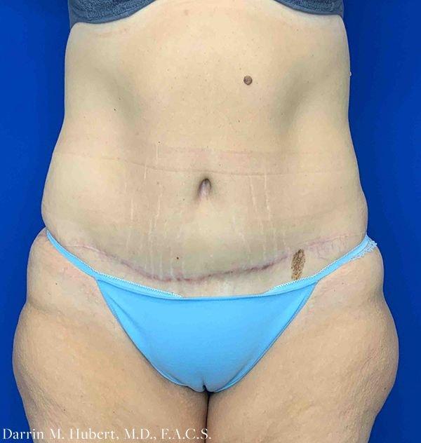 Dr. Darrin M. Hubert, MD tummy tuck after — Richmond, VA