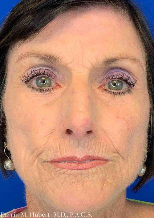 Microneedling after at Dr. Darrin M. Hubert, MD in Richmond, VA