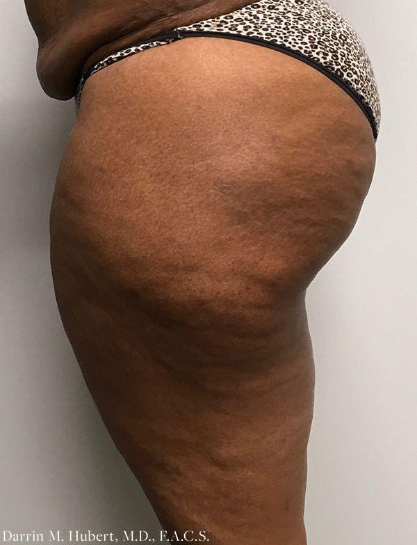 Liposuction before at Dr. Darrin M. Hubert, MD in Richmond, VA