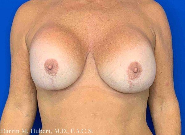 Breast Lift before at Dr. Darrin M. Hubert, MD in Richmond, VA