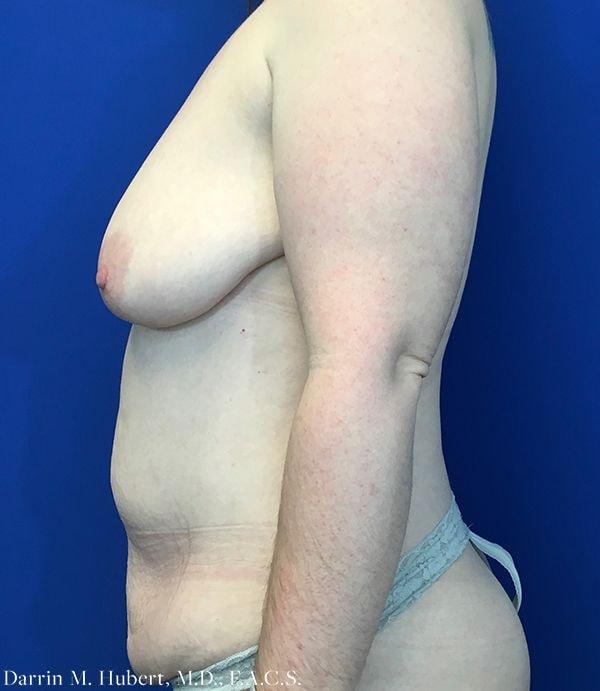 Mommy Makeover before at Dr. Darrin M. Hubert, MD in Richmond, VA