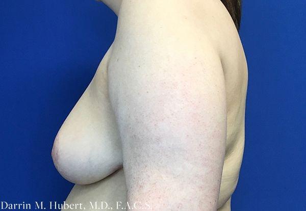 Breast Reduction after at Dr. Darrin M. Hubert, MD in Richmond, VA