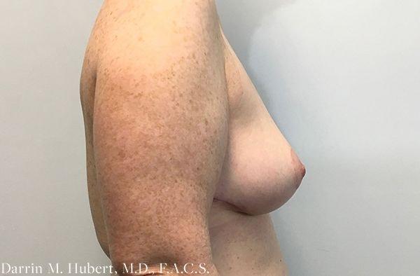 Breast Reduction after at Dr. Darrin M. Hubert, MD in Richmond, VA