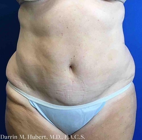 Liposuction before at Dr. Darrin M. Hubert, MD in Richmond, VA