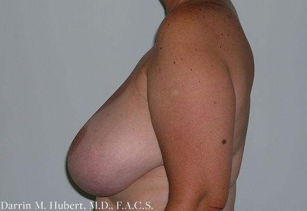 Breast Reduction before at Dr. Darrin M. Hubert, MD in Richmond, VA