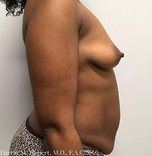 Mommy Makeover before at Dr. Darrin M. Hubert, MD in Richmond, VA