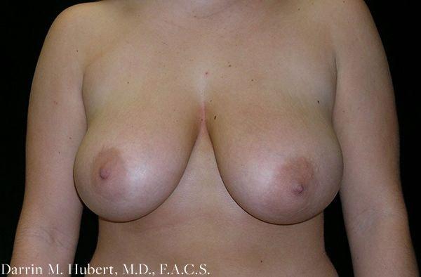 Breast Reduction before at Dr. Darrin M. Hubert, MD in Richmond, VA