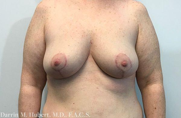 Breast Reduction after at Dr. Darrin M. Hubert, MD in Richmond, VA