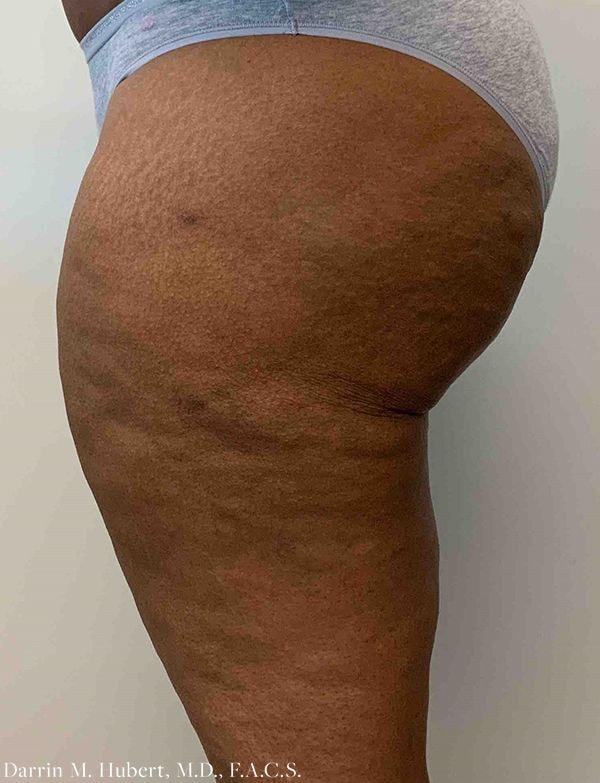 Liposuction after at Dr. Darrin M. Hubert, MD in Richmond, VA