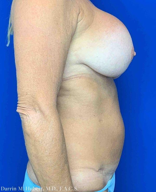 Mommy Makeover before at Dr. Darrin M. Hubert, MD in Richmond, VA