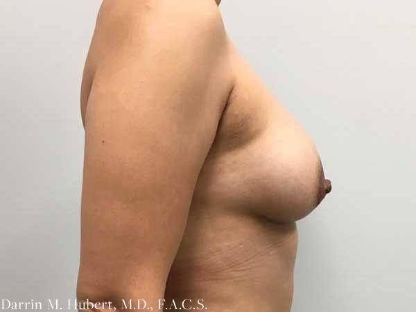 Breast Lift after at Dr. Darrin M. Hubert, MD in Richmond, VA