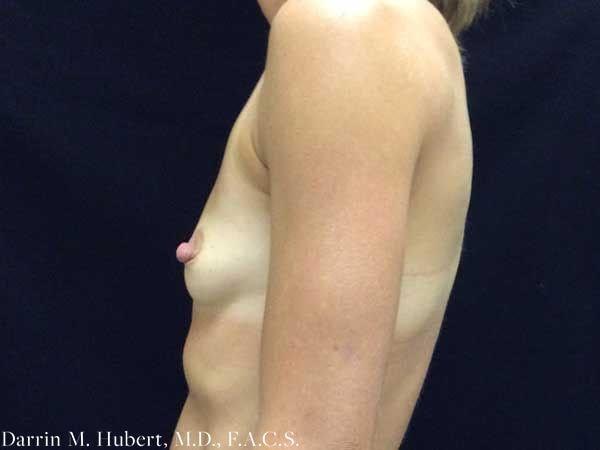 Breast Augmentation before at Dr. Darrin M. Hubert, MD in Richmond, VA
