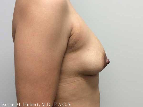 Breast Lift before at Dr. Darrin M. Hubert, MD in Richmond, VA