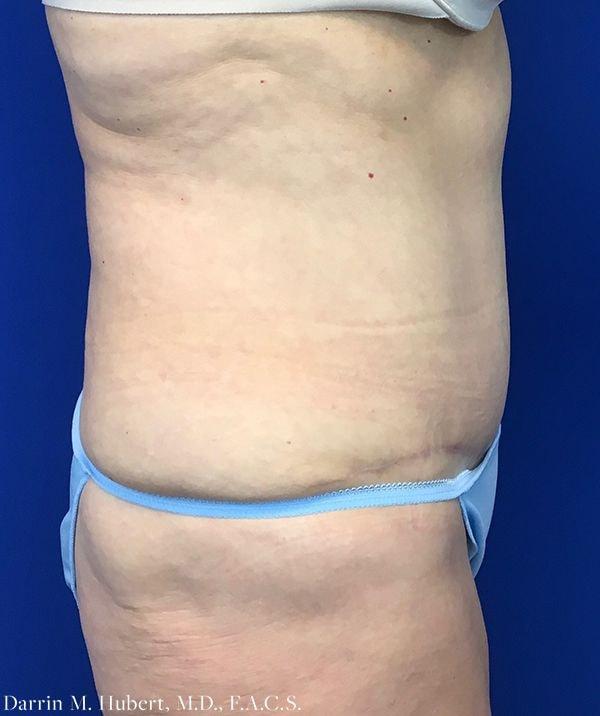Dr. Darrin M. Hubert, MD tummy tuck after — Richmond, VA