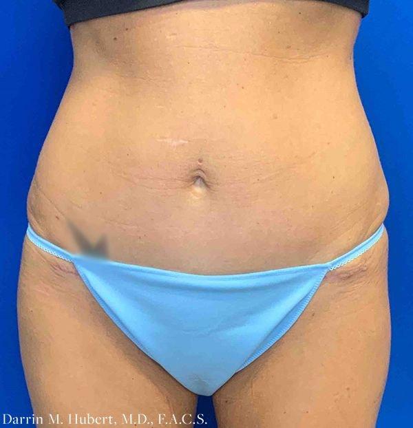 Dr. Darrin M. Hubert, MD tummy tuck after — Richmond, VA