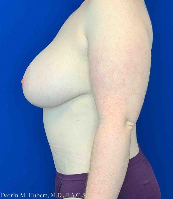 Mommy Makeover after at Dr. Darrin M. Hubert, MD in Richmond, VA