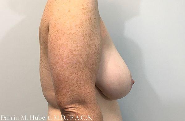 Breast Reduction before at Dr. Darrin M. Hubert, MD in Richmond, VA