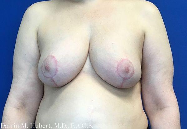 Breast Reduction after at Dr. Darrin M. Hubert, MD in Richmond, VA