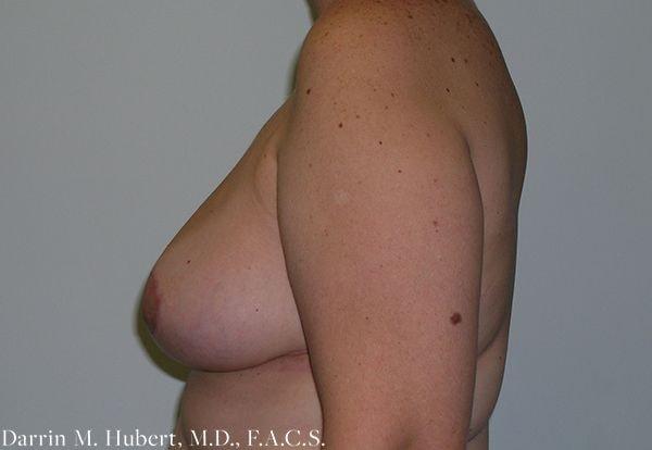 Breast Reduction after at Dr. Darrin M. Hubert, MD in Richmond, VA