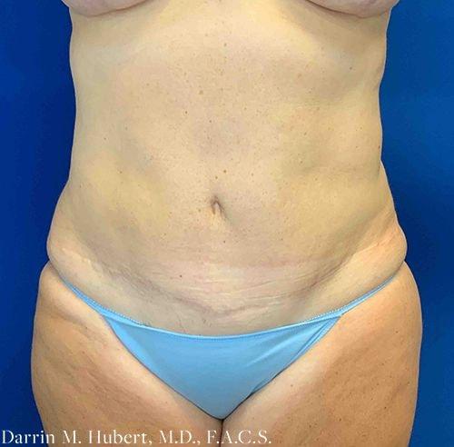 Liposuction after at Dr. Darrin M. Hubert, MD in Richmond, VA