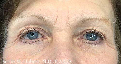 Blepharoplasty after at Dr. Darrin M. Hubert, MD in Richmond, VA