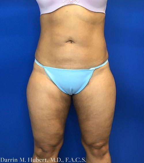 Liposuction after at Dr. Darrin M. Hubert, MD in Richmond, VA