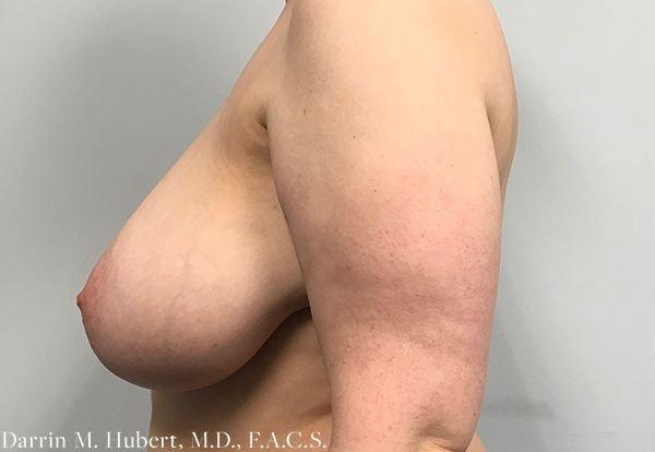 Breast Reduction before at Dr. Darrin M. Hubert, MD in Richmond, VA