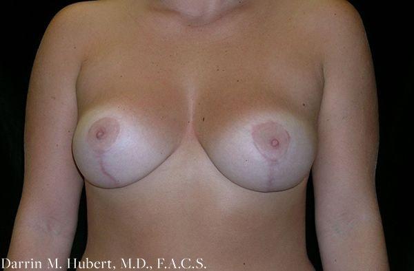 Breast Reduction after at Dr. Darrin M. Hubert, MD in Richmond, VA