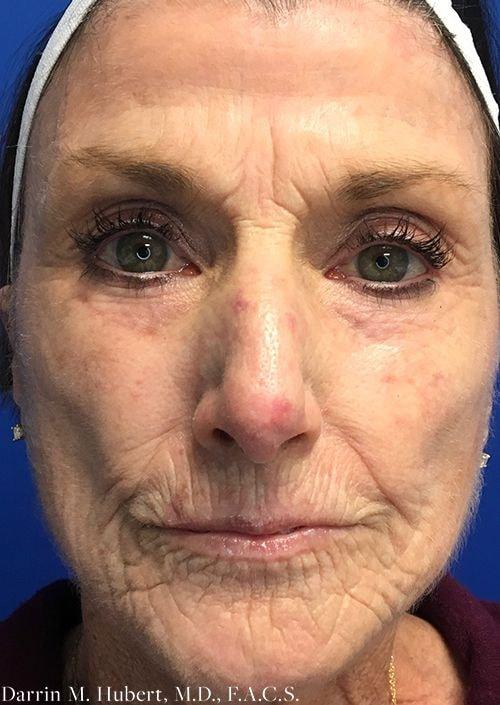 Microneedling before at Dr. Darrin M. Hubert, MD in Richmond, VA
