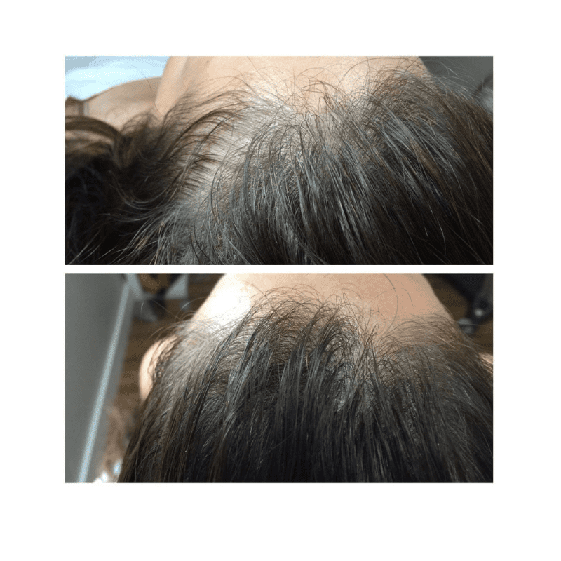 Glow Medispa result — Seattle, WA