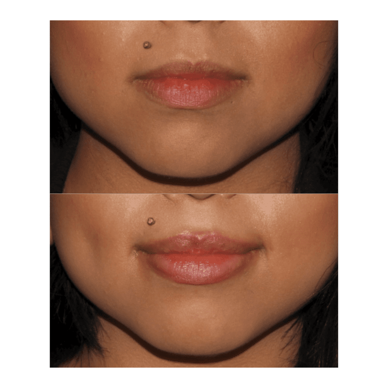 Glow Medispa lip filler result — Seattle, WA