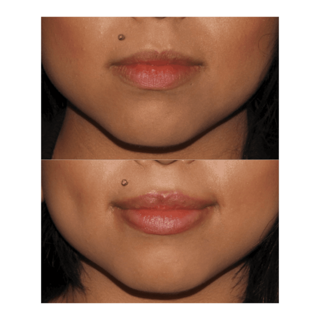 Lip Filler result at Glow Medispa in Seattle, WA