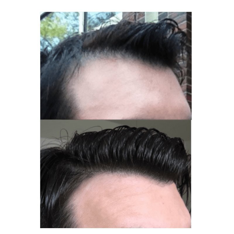 Glow Medispa result — Seattle, WA