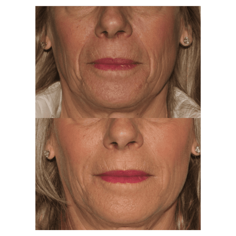 Glow Medispa lip filler result — Seattle, WA