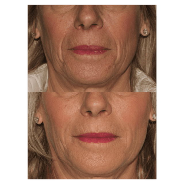Lip Filler result at Glow Medispa in Seattle, WA