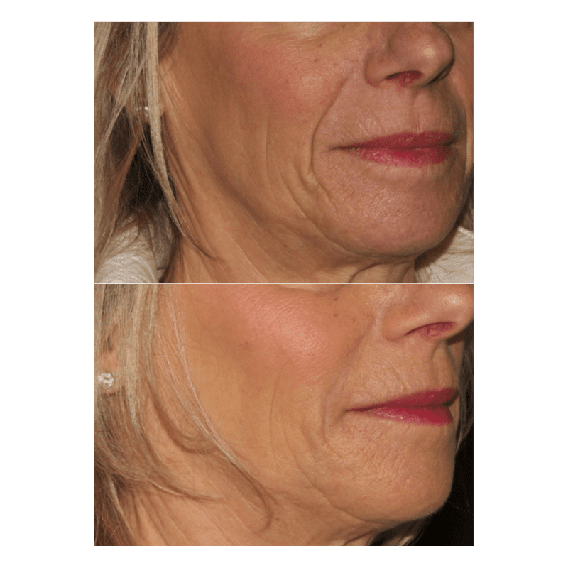 Glow Medispa lip filler result — Seattle, WA