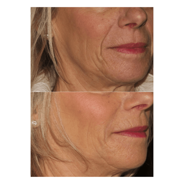 Lip Filler result at Glow Medispa in Seattle, WA