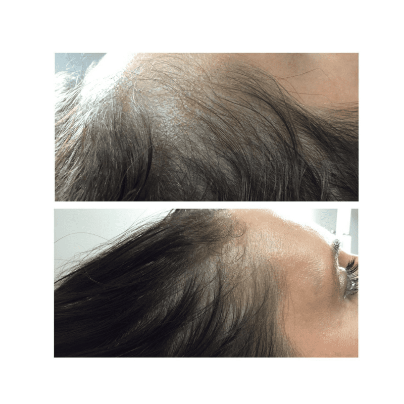 Glow Medispa result — Seattle, WA