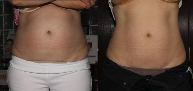 CoolSculpting result at Glow Medispa in Seattle, WA