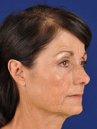 Shapiro Plastic Surgery facelift after — Scottsdale, AZ