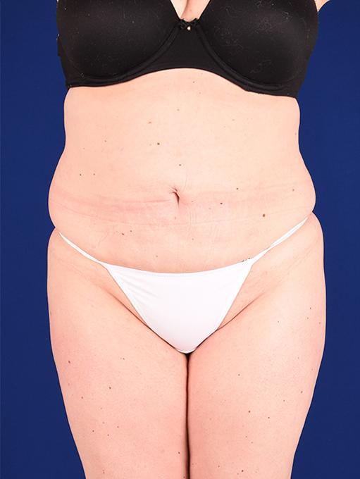 Shapiro Plastic Surgery tummy tuck after — Scottsdale, AZ