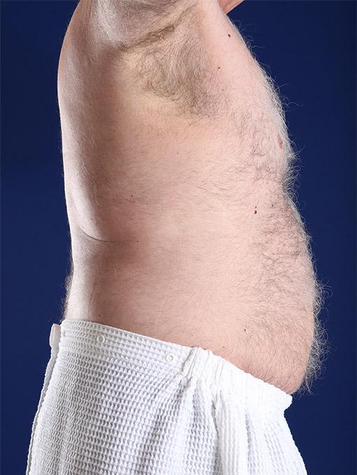 Liposuction after at Shapiro Plastic Surgery in Scottsdale, AZ