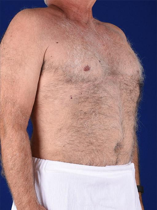 Liposuction before at Shapiro Plastic Surgery in Scottsdale, AZ