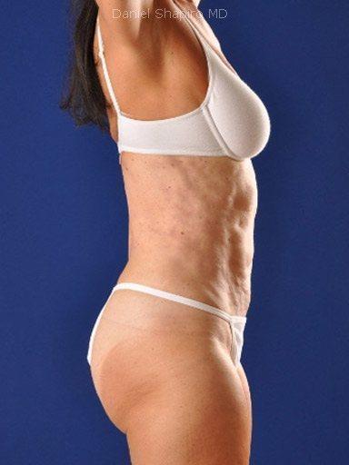 Liquid BBL before at Shapiro Plastic Surgery in Scottsdale, AZ