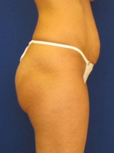 Liposuction after at Shapiro Plastic Surgery in Scottsdale, AZ