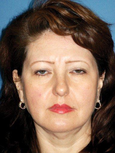 Shapiro Plastic Surgery blepharoplasty after — Scottsdale, AZ
