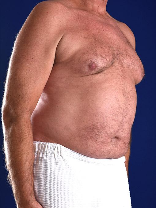 Gynecomastia Surgery after at Shapiro Plastic Surgery in Scottsdale, AZ