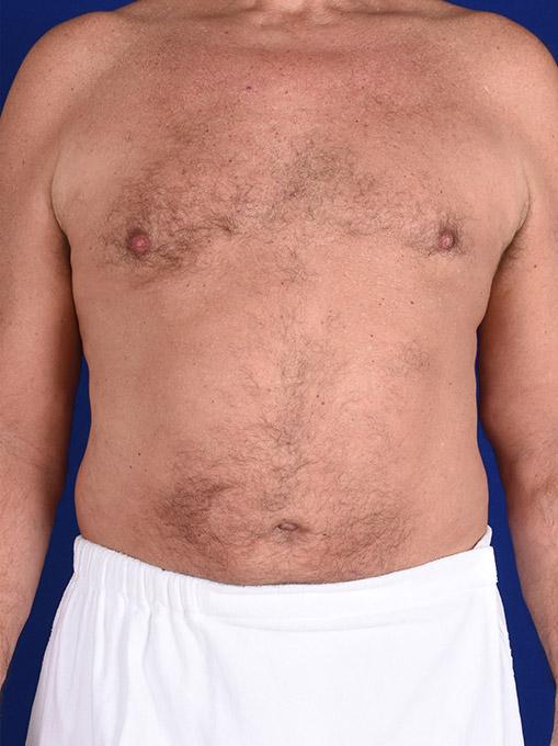 Gynecomastia Surgery before at Shapiro Plastic Surgery in Scottsdale, AZ