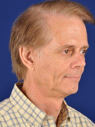 Shapiro Plastic Surgery fat transfer after — Scottsdale, AZ