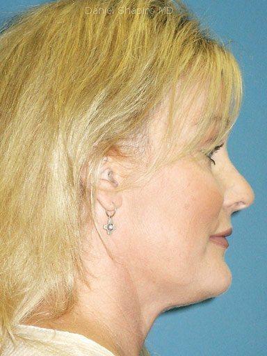 Brow Lift before at Shapiro Plastic Surgery in Scottsdale, AZ